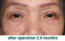 plastic-surgery-blepharoplasty